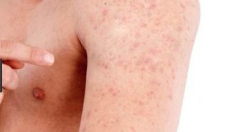 Tratamento Natural para se livrar da Queratose Pilar (pele de galinha) queratosi pilar em braço